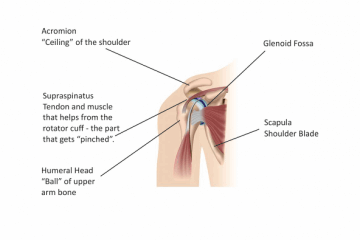 Cortisone injection