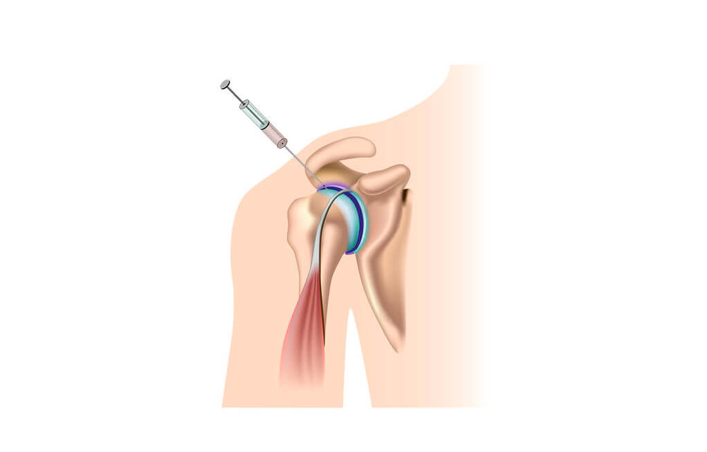 cortisone-injection