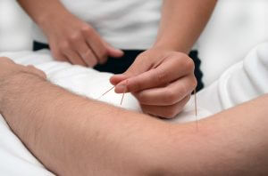 Acupuncture lakky physiotherapy Basingstoke