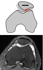 maltrack-kneecap-increased-contact-area