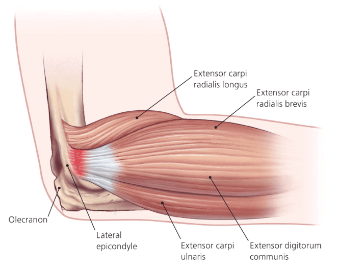 tennis-elbow