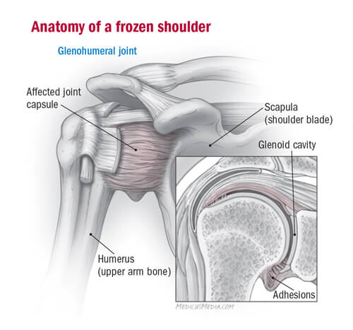 frozen-shoulder