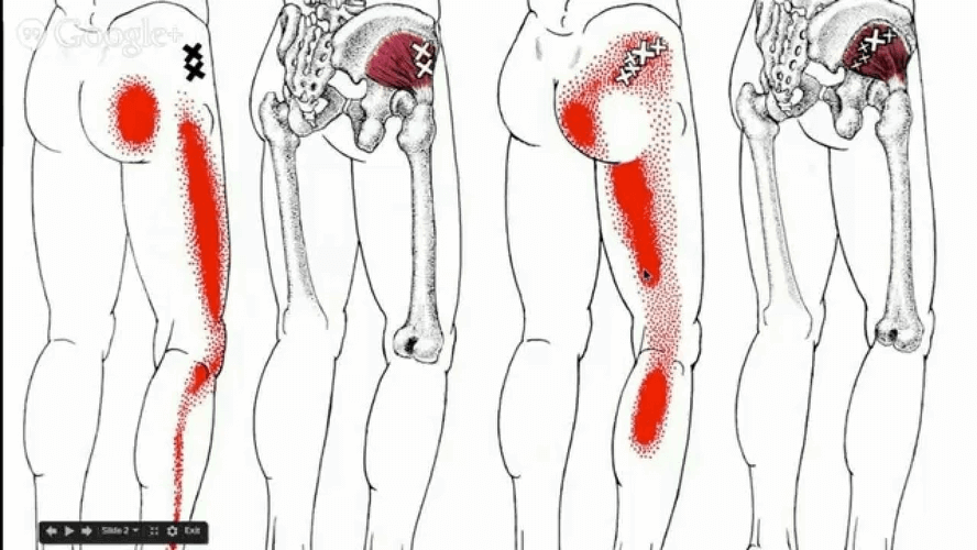 hip-muscle-trigger-points