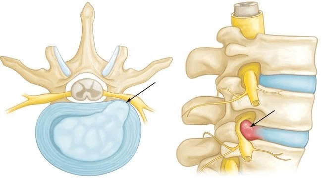 lumbar-spine-disc-bulge